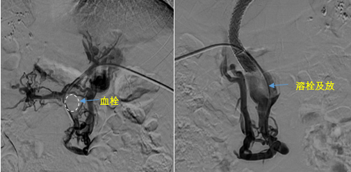 血栓攔路，如何破局——罕見(jiàn)巨大門靜脈血栓TIPS手術(shù)實(shí)錄
