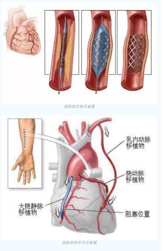 魚與熊掌不可兼得？冠脈雜交手術(shù)一站式解決問題