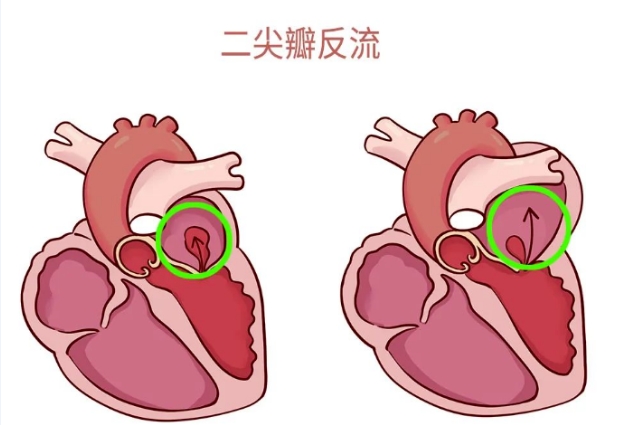 體檢報告里的心臟瓣膜反流，你讀懂了嗎？