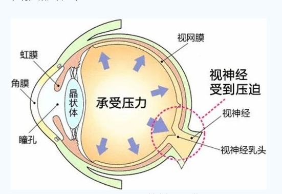 世界青光眼日｜共管慢病青光眼 留得光明恒久遠(yuǎn)